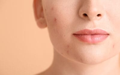 Venus Viva™MD : la radiofréquence fractionnée, une nouvelle solution contre les cicatrices d’acné ?