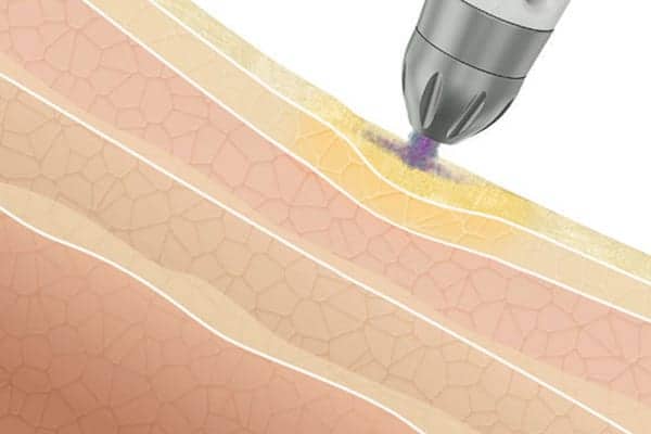 mesotherapie schema penetration barriere de la peau clinique esthetique paris esthetical centre de medecine esthetique paris